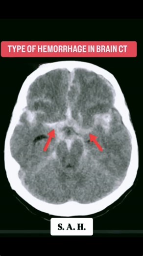 RK NURSE'S HUB on Instagram: "SAH, or Subarachnoid Hemorrhage, is a serious medical emergency involving bleeding in the space between the brain and its covering membranes, often from a ruptured aneurysm or head injury, causing a sudden, severe "thunderclap" headache, stiff neck, nausea, and potential loss of consciousness, requiring immediate diagnosis (CT scan) and treatment (surgery/clipping) to prevent severe disability or death. Causes Ruptured Cerebral Aneurysm: Most common cause of spontan