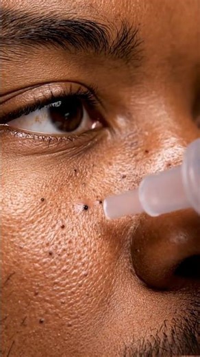 From Clogged to Clear Cheek Blackhead Removal