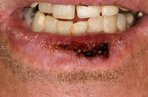 Lip Cancer - Pictures, Causes, Symptoms, Treatment