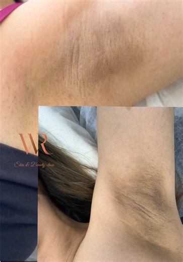 Smart peel est un peeling intelligent pour éclaircir les aisselles même en éte sans que la peau pèle et sans risque de brûlure Profitez des à présent de notre expertise a Skin & Beauty Clinic au 51 810 811 #waad_rhaiem #peeling #underarmwhitening #تقشير #تفتيح_البشرة