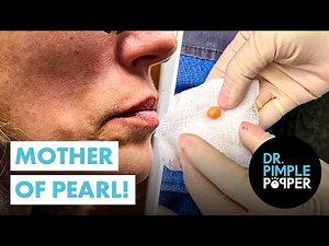 Dr. Pimple Popper Finds a Rare Pearl-Like Cyst Under the Skin — So Satisfying!
