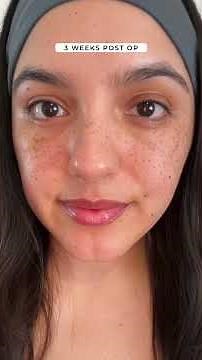 Lower blepharoplasty with fat repositioning and Microneedling - healing journey