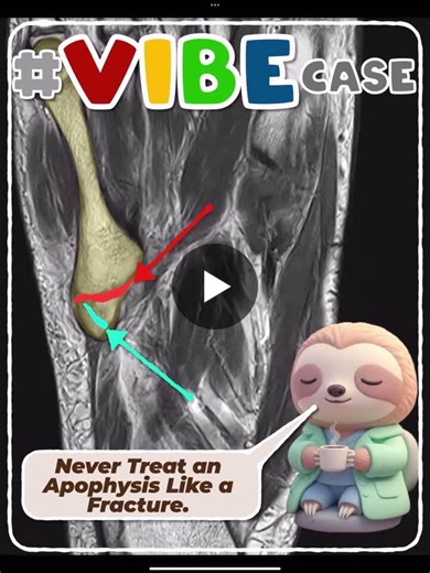 Fifth Metatarsal Apophysis vs Fracture: Key Differences | Jee Eun Lee posted on the topic | LinkedIn