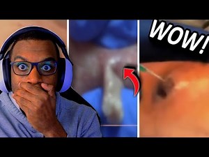 TikTok's Craziest Pimple Popping Videos - Reaction Compilation