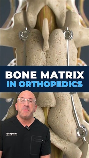 What Happens When You Get A Bone Graft? #surgery #health #science
