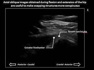 Lateral snapping hip syndrome (coxa saltans) on dynamic hip ultrasound (case 2)