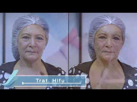 HIFU: Lifting Facial - Tratamiento Tensor - Rejuvenecimiento Facial
