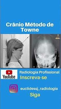 Skull Towne Method #radiologiacarioca #radiologytechnologist #radiology