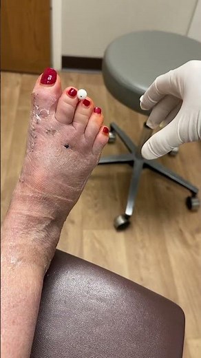 Foot Surgery Journey: Removing K-Wires - A Step Towards Recovery #shorts