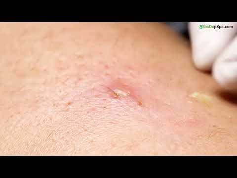 🤯 Blackhead Removal GONE WRONG?! 😱 You WON'T BELIEVE This! 🔥😂