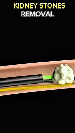 30K views · 325 reactions | kidney stones removal #KidneyStones #KidneyStoneRemoval #Ureteroscopy #KidneyHealth #StoneFree #KidneyStoneTreatment #UrologyCare #UreteroscopyRecovery #KidneyStonePrevention #KidneyStonePain #KidneyStoneJourney #EndKidneyStones #StoneRemoval #UreteroscopyProcedure #HealthyKidneys | Surgery Page | Facebook