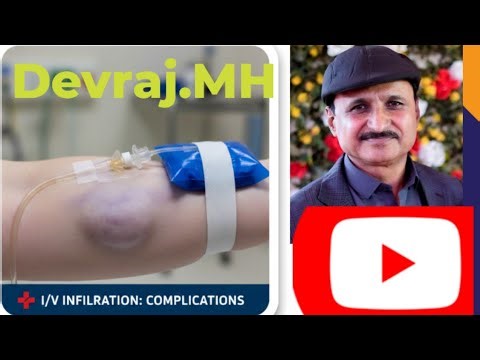 What is I/V. Infiltration? How we handle it.?