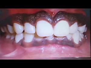 Gingival Pigmentation by dr. Alka khade.