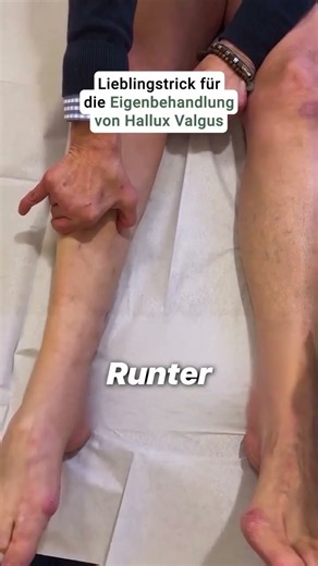 Der Hallux Valgus entsteht oft nicht nur durch Fehlstellung, sondern auch durch verklebte Faszien im