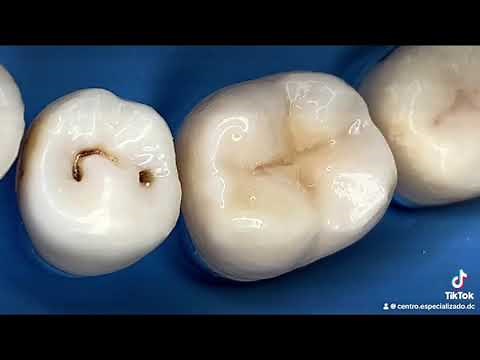 ¡🔥Proceso completo para eliminar caries dental y restaurar una muela picada con material blanco🔥!