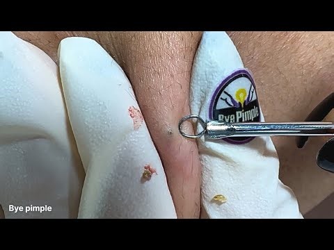 Extracting blackheads from the back(bacne):Relax with bye pimple