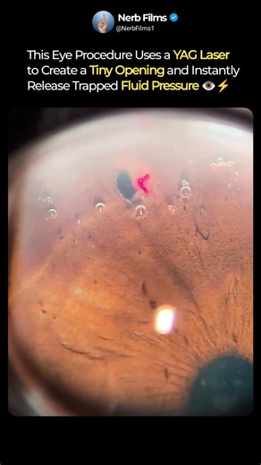 Laser Iris Opening 👁️⚡