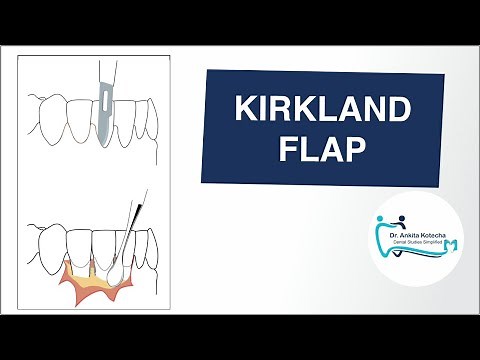 KIRKLAND FLAP/ ACCESS FLAP/ MODIFIED FLAP OPERATION/ PERIODONTAL FLAP SURGERY TECHNIQUE/DR. ANKITA K
