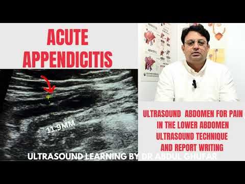 Appendix ultrasound | appendix ultrasound normal vs abnormal | appendix ultrasound technique | Usg