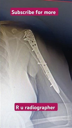 shoulder Ap with arm #medical #facts #radiology #anatomy #abcs #hospital #doctor #xray