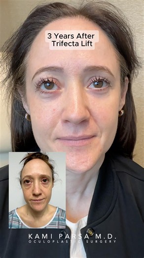 Trifecta Lift Results 3 Years Later!