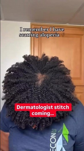 The Hair Loss That Never Grows Back… (Scarring Alopecia'(CCCA) Explained) #alopecia