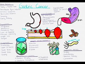 Understanding Gastric Cancer: risk factors, symptoms, diagnosis, treatment, precancerous lesions