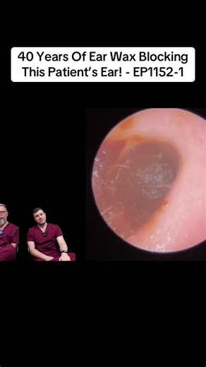40 Years Of Ear Wax Blocking This Patient’s Ear! - EP1152-1 | clogged ear wax removal