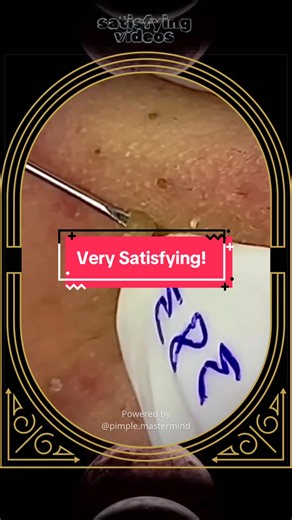 Blackheads removal | Skincare Satisfying Video | Pimple Patch #blackheadsremoval #blackheads #pimplepatch #skincare #pimplepopper