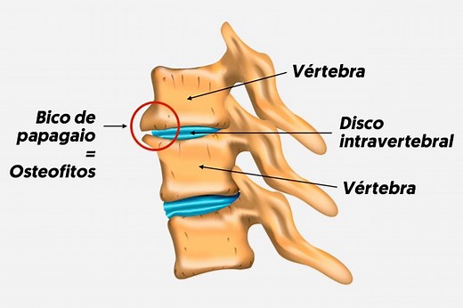 Picos de loro (osteofitos): qué son, síntomas y tratamiento
