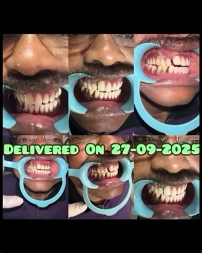 Missing teeth Replacement through Removable partial Denture&Flexible Partial Denture