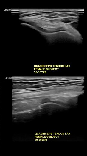 #ultrasound Guided Interventions: Healthy quadriceps tendon