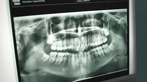 Dentist Examining Teeth X-ray Plates Stock Footage Video (100% Royalty-free) 1100620971 | Shutterstock