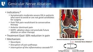 Optimizing Genicular Nerve Ablation: Patient Selection and Procedural Pearls