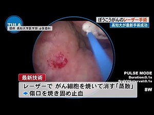 国内初！《レーザー》で「ぼうこうがん」を治療 高知大学「将来は日帰り手術も可能に」【高知】 (24/04/17 19:30)