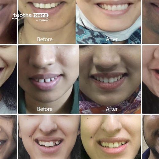 Transform your child's smile with toothsi aligners! Say goodbye to braces and hello to confident selfies. Get started today! ⭐ Totally Invisible vs. Regular Braces ⭐ 3 lakhs smiles designed ⭐ 100 In-house Dentists and Orthodontists ⭐ Founded and operated by India’s top Orthodontists | toothsi by makeO