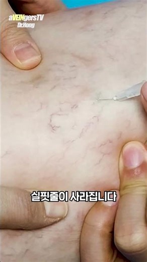 신기한 혈관 경화 주사 치료 영상!! #하지정맥류 #하지정맥류수술 #하지정맥류치료 #혈관경화주사