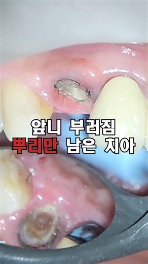 앞니 부러짐, 뿌리만 남은치아 임플란트 하지않고...자연치아 보존