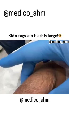 @medico_ahm | Skin tags (acrochordons) are benign, non-cancerous skin growths that are very common, affecting roughly half of all adults at some point in... | Instagram