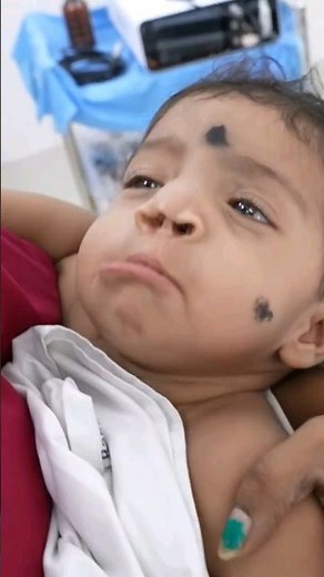 Palate Baby Going under Anesthesia