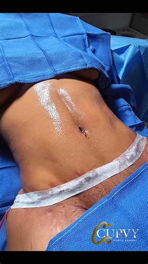 Curvy Plastic Surgery on Instagram: "A tummy tuck is a surgical procedure that removes excess skin and fat from the abdomen and restores weakened abdominal muscles 💪. It's common after significant weight changes or pregnancy. ✨"