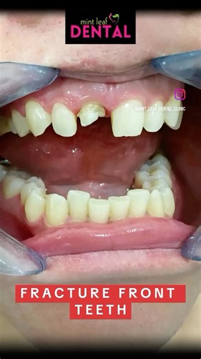 Broken tooth - Zirconia Crowns best artificial option with most natural look !