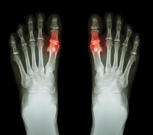 What Is Freiberg's Disease? | Silverman Ankle & Foot