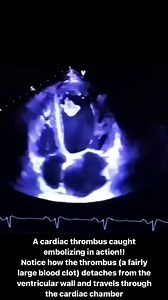 271K views · 43 reactions | A cardiac thrombus caught embolizing in...