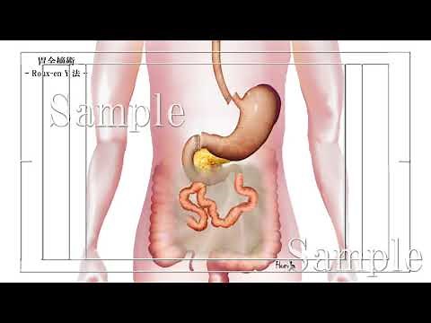 胃全摘術 Roux-en-Y法 再建イメージ