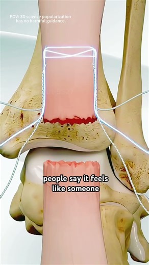 Achilles tendon repair surgery | 3d animation