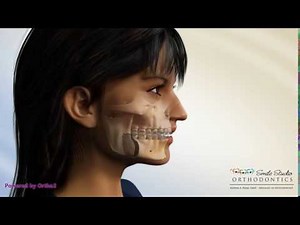 BSSO Mandibular Advancement With Face