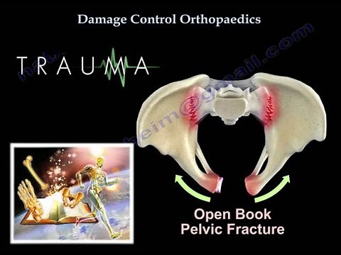 Damage Control Orthopaedics - Everything You Need To Know - Dr. Nabil Ebraheim