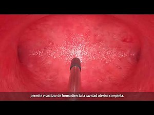 Endosee Advance (Videohisteroscopía de consultorio)