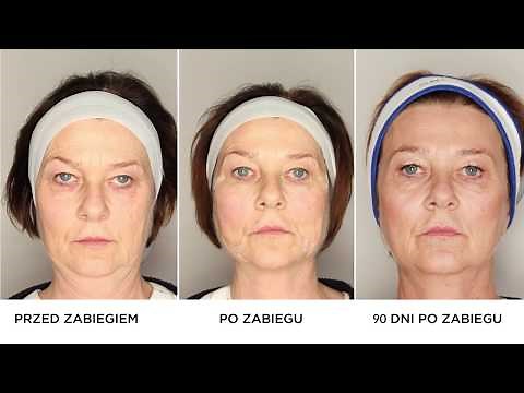Lifting twarzy nićmi Aptos